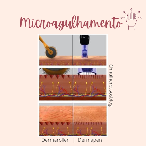 Microagulhamento diferenças entre o dermaroller ou dermapen 