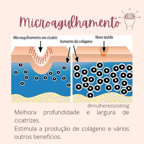Como o microagulhamento melhora a pele. Microagulhamento para cicatriz de acne, catapora, poros e linhas de expressão 